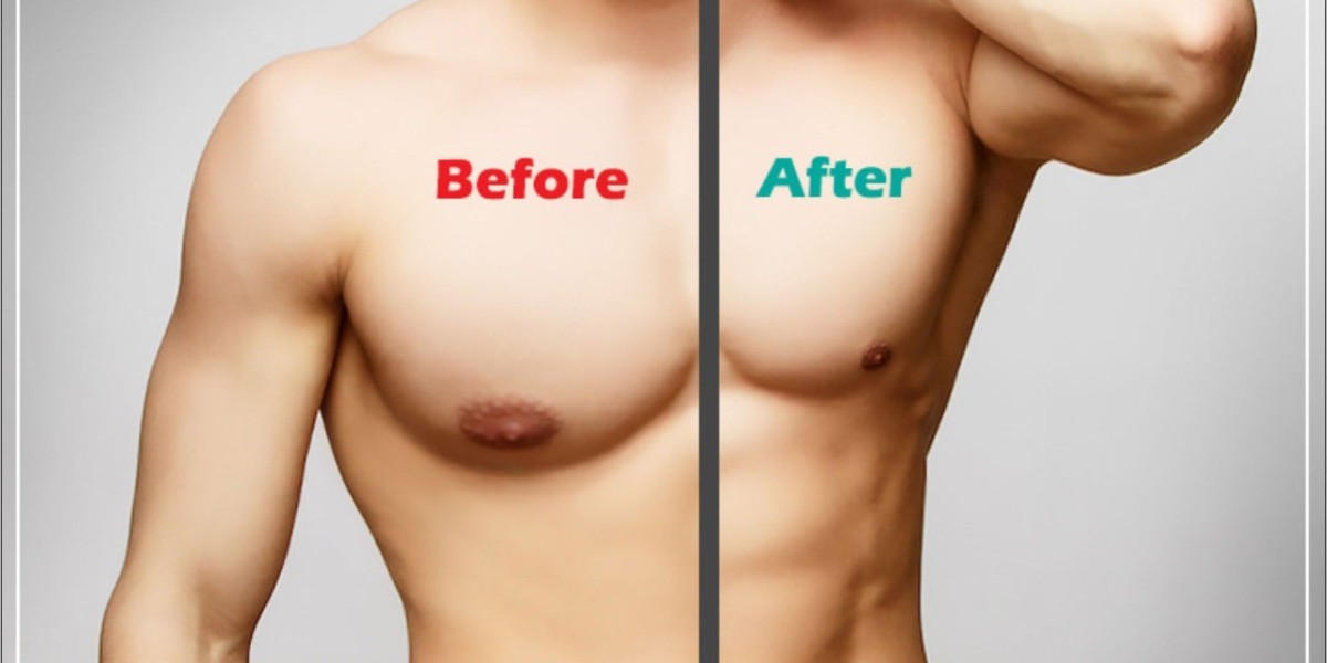 Achieve a Sculpted Chest: Male Chest Reduction in Ludhiana by Dr. Vikas Gawri