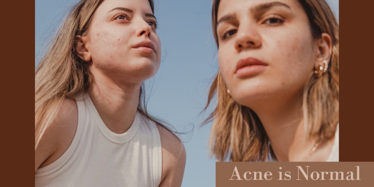 Accutane: A Comprehensive Guide to Acne Treatment