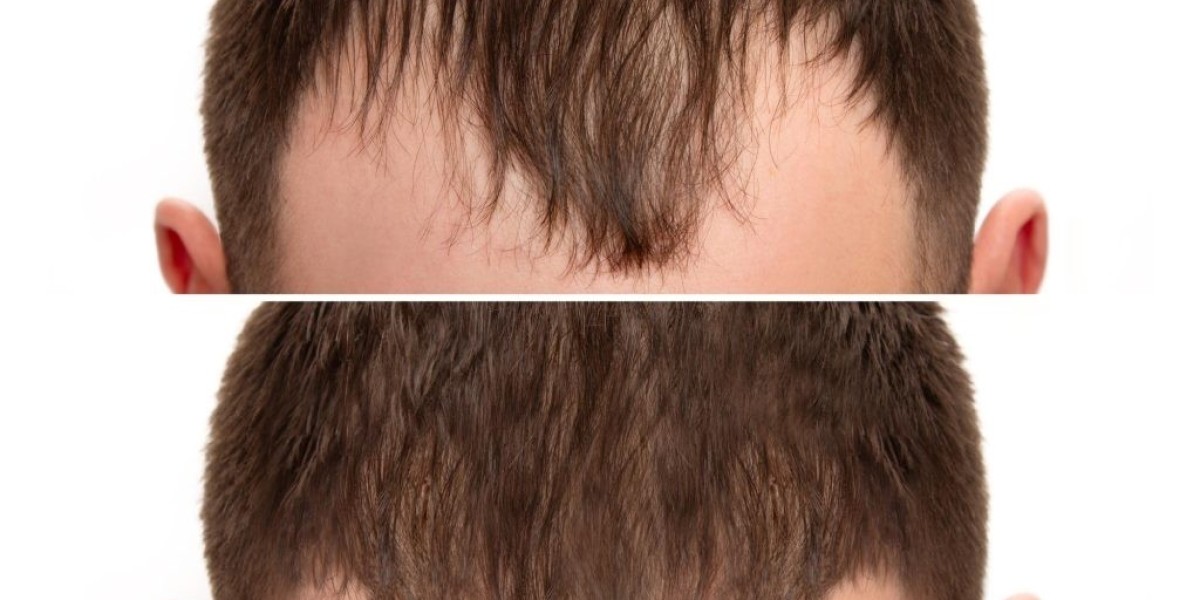 An Overview of Follicular Unit Extraction (FUE) Hair Transplants