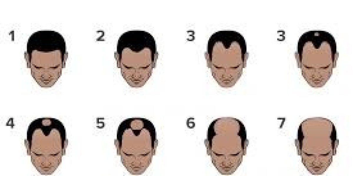 Stage 2 Hair Loss Treatment