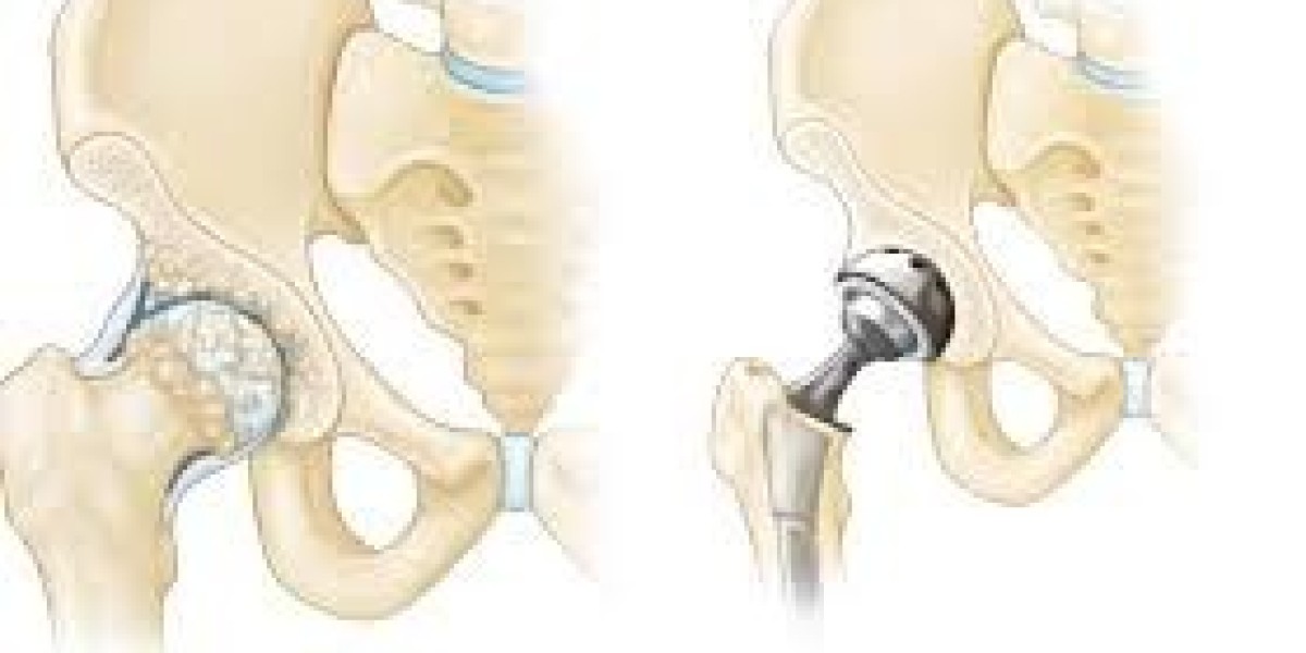 Finding the Best Joint Replacement Specialist in Delhi