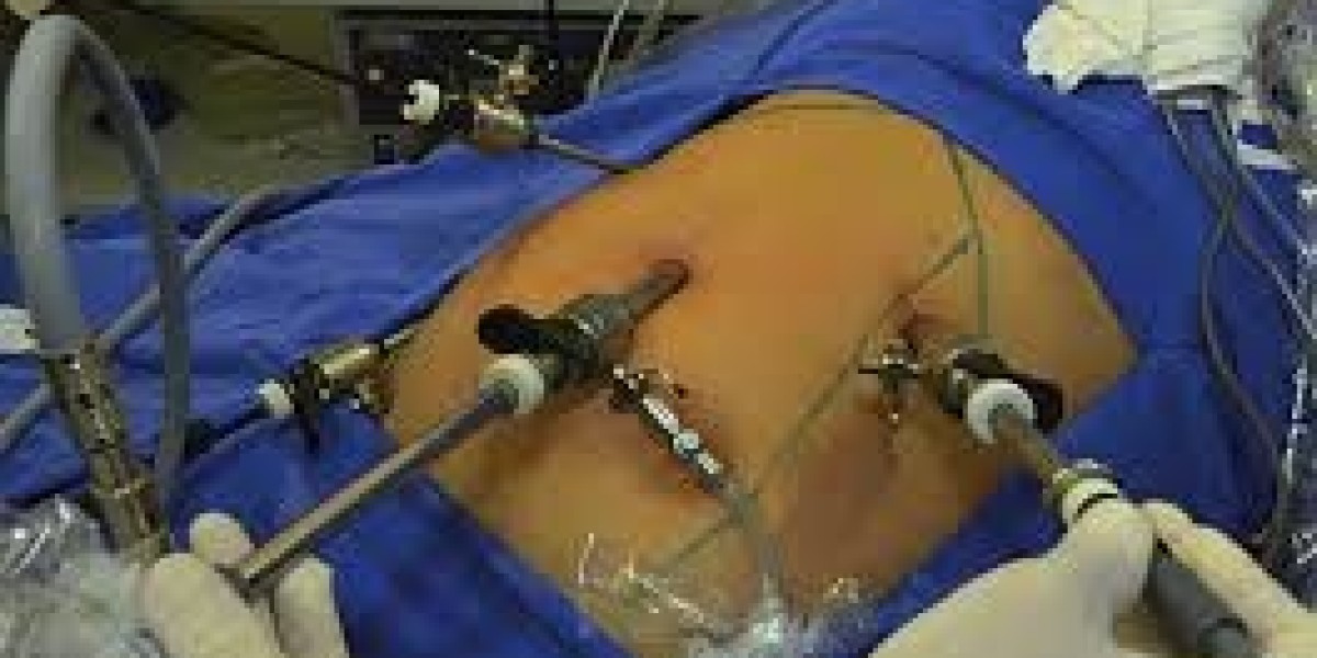 Advanced Laparoscopic Cholecystectomy Surgery in Mumbai: Minimally Invasive and Effective Gallbladder Removal