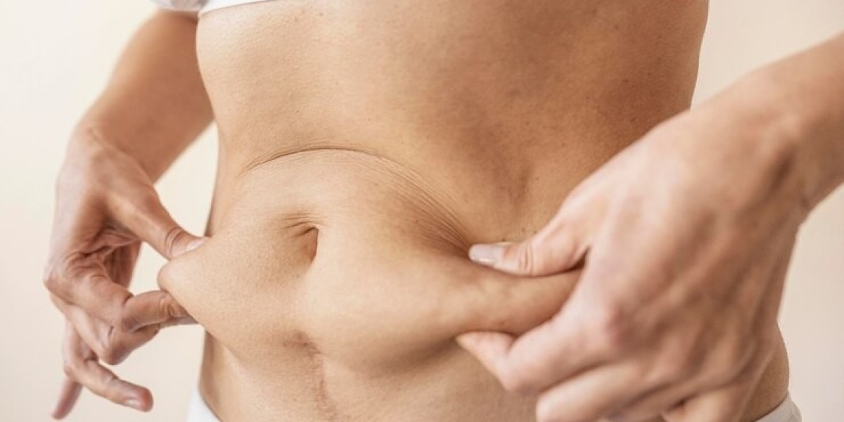 Everything You Need to Know About Tummy Tuck Surgery in Chandigarh