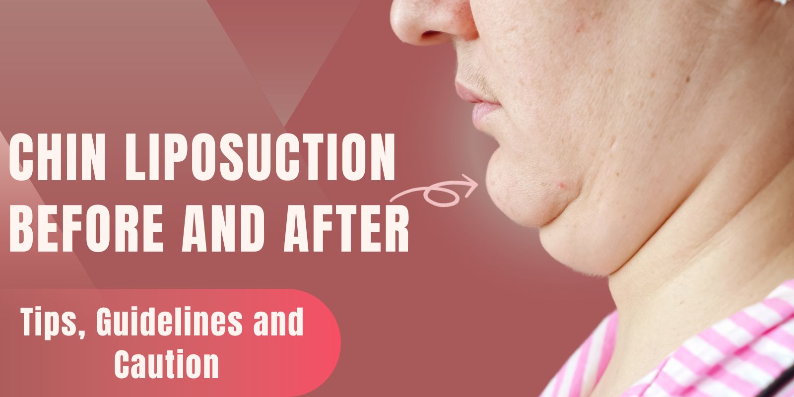 Chin liposuction before and after: tips, guidelines and caution