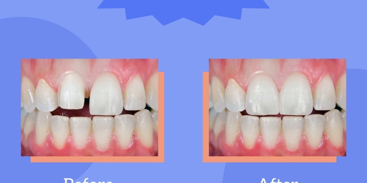 Smile Makeover Cost: All You Need to Know