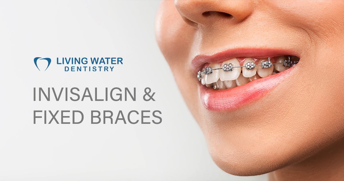 Fixed Braces & Invisalign in Surrey | Orthodontics Treatment